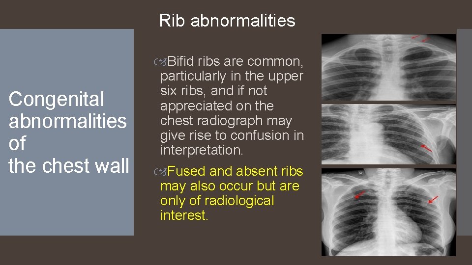 Rib abnormalities Congenital abnormalities of the chest wall Bifid ribs are common, particularly in