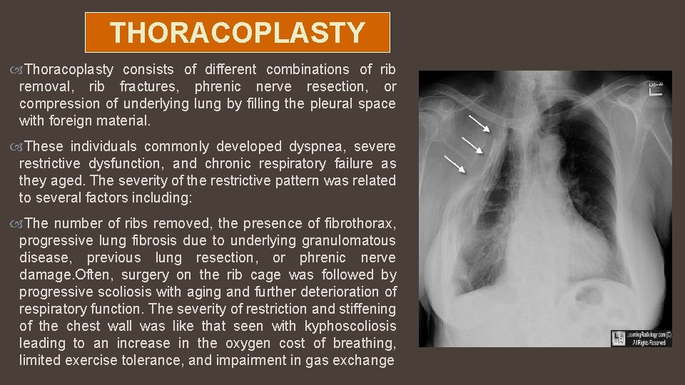 THORACOPLASTY Thoracoplasty consists of different combinations of rib removal, rib fractures, phrenic nerve resection,