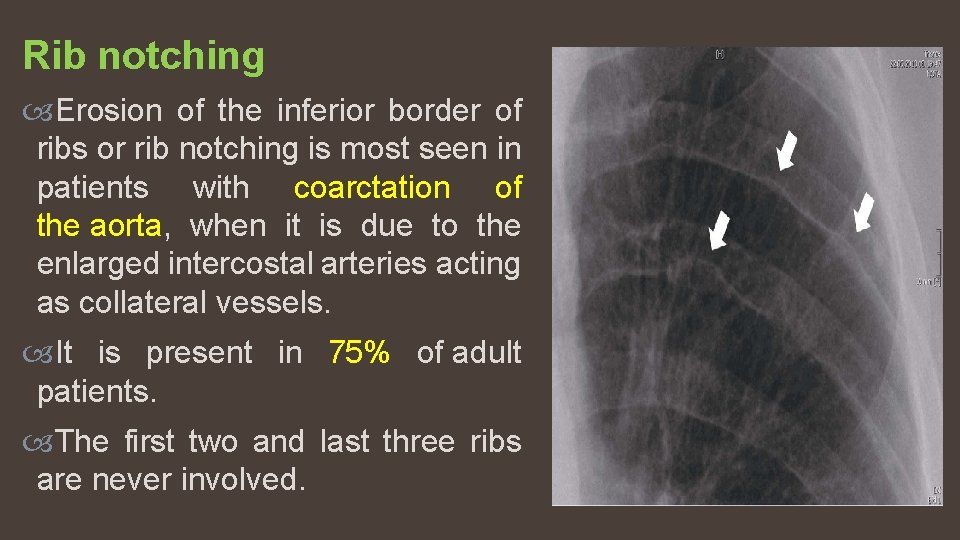 Rib notching Erosion of the inferior border of ribs or rib notching is most