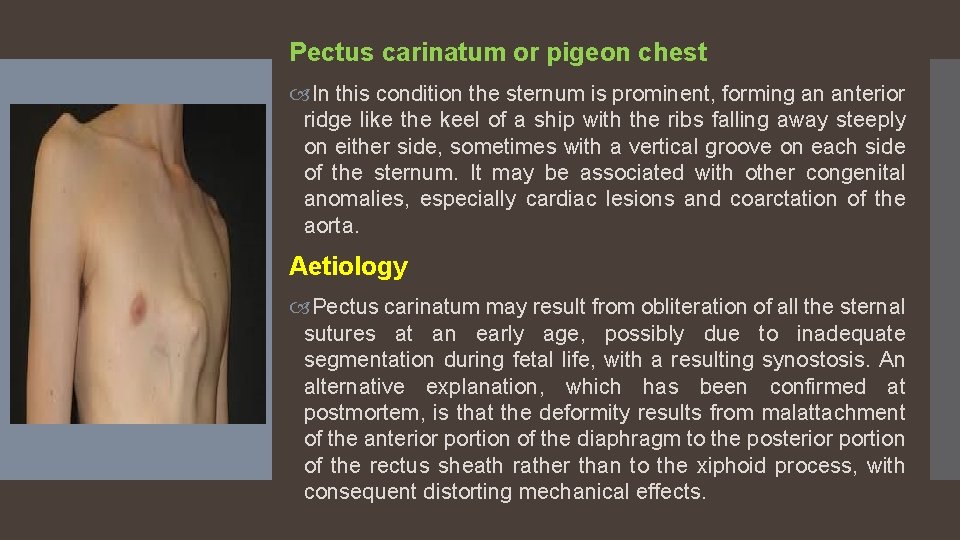 Pectus carinatum or pigeon chest In this condition the sternum is prominent, forming an