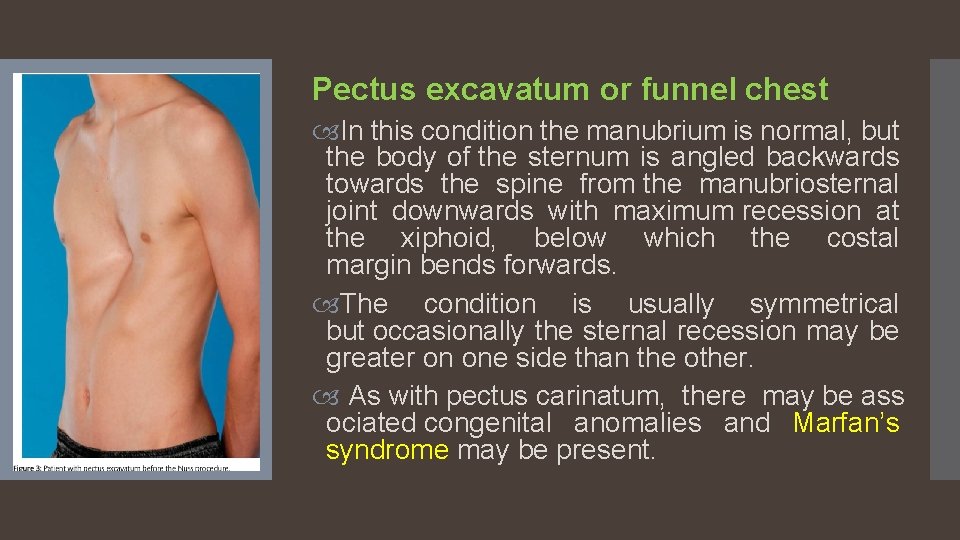 Pectus excavatum or funnel chest In this condition the manubrium is normal, but the