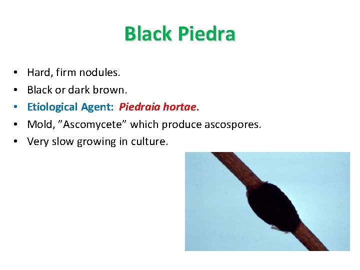 Black Piedra • • • Hard, firm nodules. Black or dark brown. Etiological Agent: