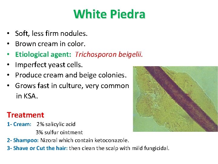 White Piedra • • • Soft, less firm nodules. Brown cream in color. Etiological