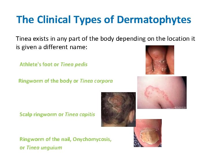 The Clinical Types of Dermatophytes Tinea exists in any part of the body depending