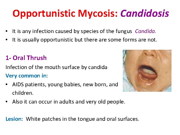 Opportunistic Mycosis: Candidosis • It is any infection caused by species of the fungus