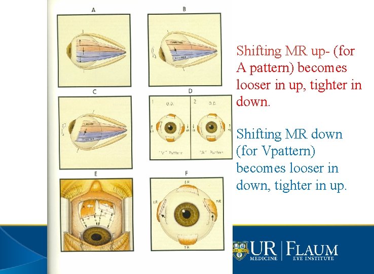 Shifting MR up- (for A pattern) becomes looser in up, tighter in down. Shifting