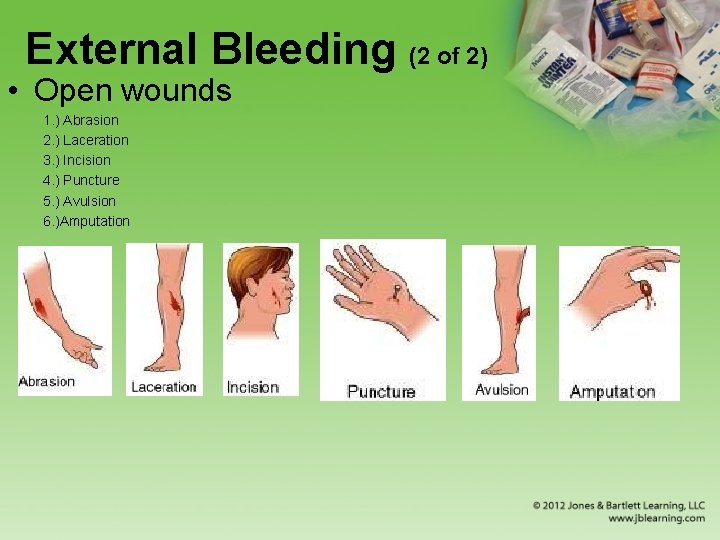 External Bleeding (2 of 2) • Open wounds 1. ) Abrasion 2. ) Laceration