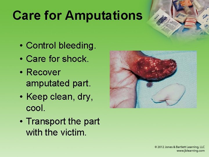 Care for Amputations • Control bleeding. • Care for shock. • Recover amputated part.