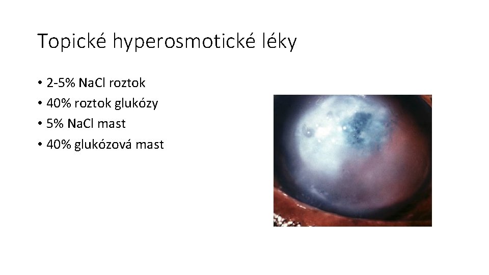 Topické hyperosmotické léky • 2 -5% Na. Cl roztok • 40% roztok glukózy •