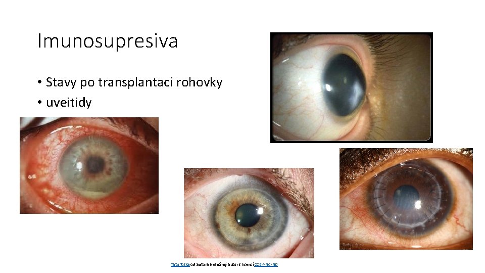 Imunosupresiva • Stavy po transplantaci rohovky • uveitidy Tato fotka od autora Neznámý autor