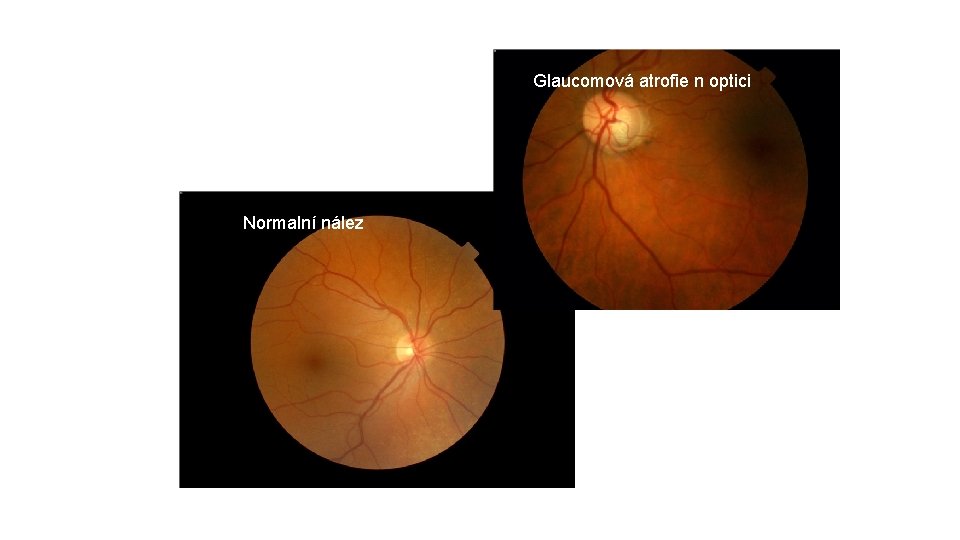 Glaucomová atrofie n optici Normalní nález 
