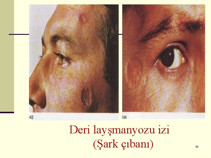 Deri layşmanyozu izi (Şark çıbanı) 10 
