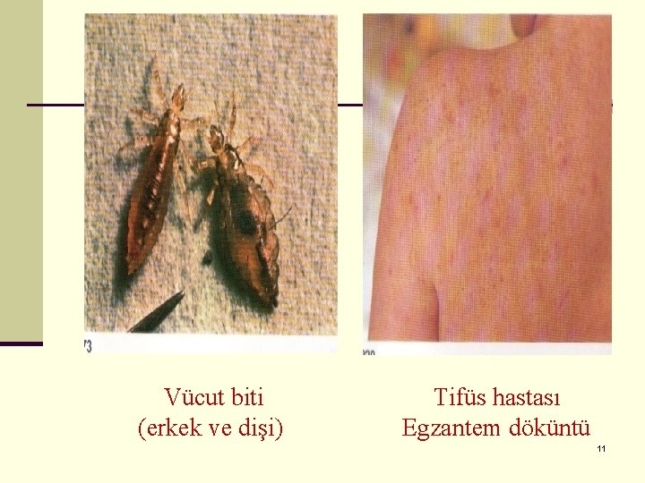 Vücut biti (erkek ve dişi) Tifüs hastası Egzantem döküntü 11 