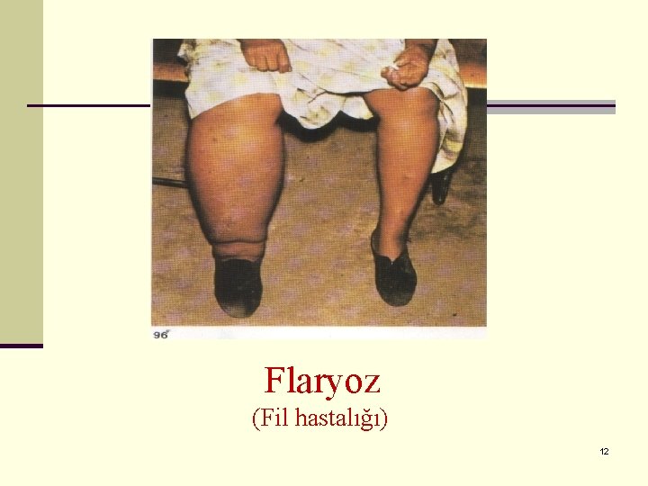 Flaryoz (Fil hastalığı) 12 