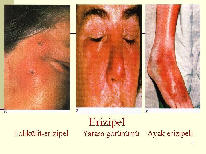 Erizipel Folikülit-erizipel Yarasa görünümü Ayak erizipeli 6 