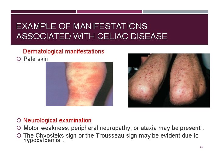 EXAMPLE OF MANIFESTATIONS ASSOCIATED WITH CELIAC DISEASE Dermatological manifestations Pale skin Neurological examination Motor