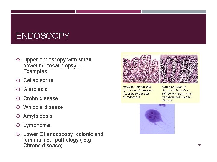 ENDOSCOPY v Upper endoscopy with small bowel mucosal biopsy…. Examples Celiac sprue Giardiasis Crohn