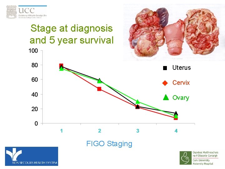 Stage at diagnosis and 5 year survival Uterus Cervix Ovary FIGO Staging 