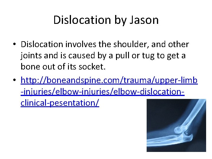 Dislocation by Jason • Dislocation involves the shoulder, and other joints and is caused