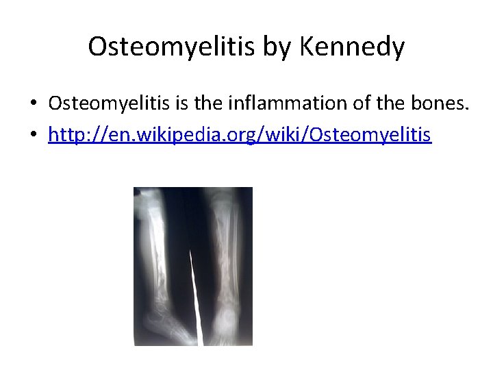 Osteomyelitis by Kennedy • Osteomyelitis is the inflammation of the bones. • http: //en.