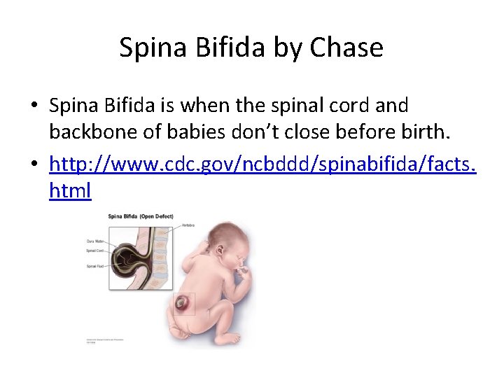 Spina Bifida by Chase • Spina Bifida is when the spinal cord and backbone