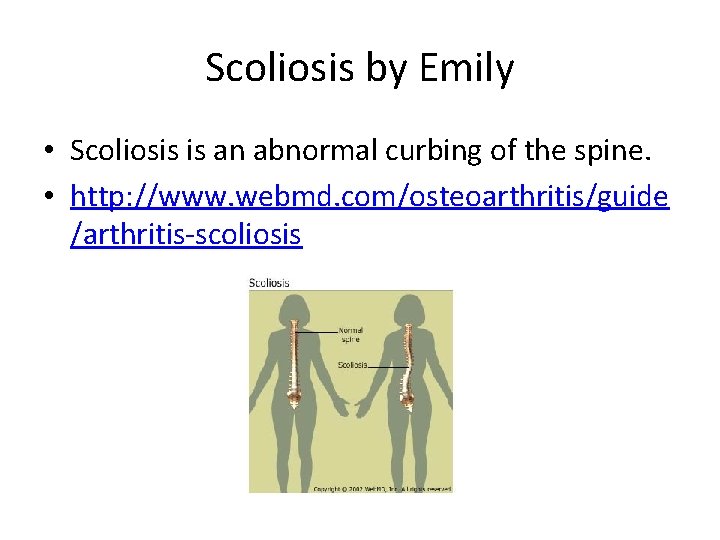 Scoliosis by Emily • Scoliosis is an abnormal curbing of the spine. • http: