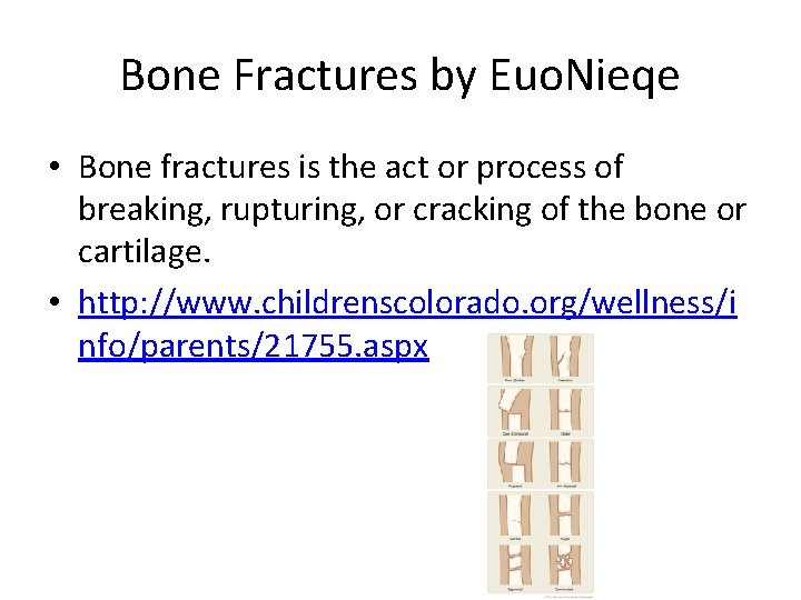 Bone Fractures by Euo. Nieqe • Bone fractures is the act or process of