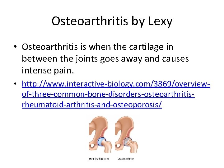 Osteoarthritis by Lexy • Osteoarthritis is when the cartilage in between the joints goes