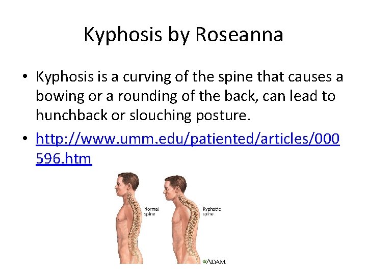 Kyphosis by Roseanna • Kyphosis is a curving of the spine that causes a