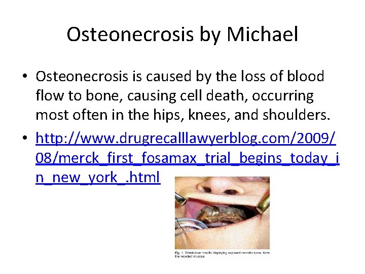 Osteonecrosis by Michael • Osteonecrosis is caused by the loss of blood flow to