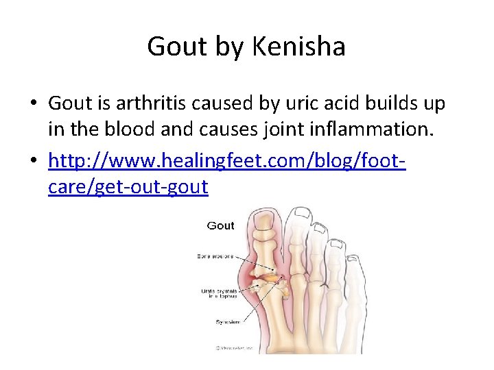 Gout by Kenisha • Gout is arthritis caused by uric acid builds up in