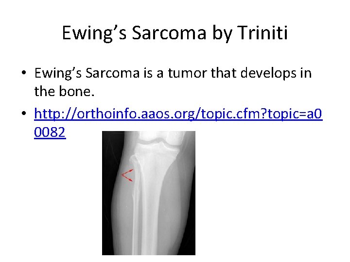 Ewing’s Sarcoma by Triniti • Ewing’s Sarcoma is a tumor that develops in the