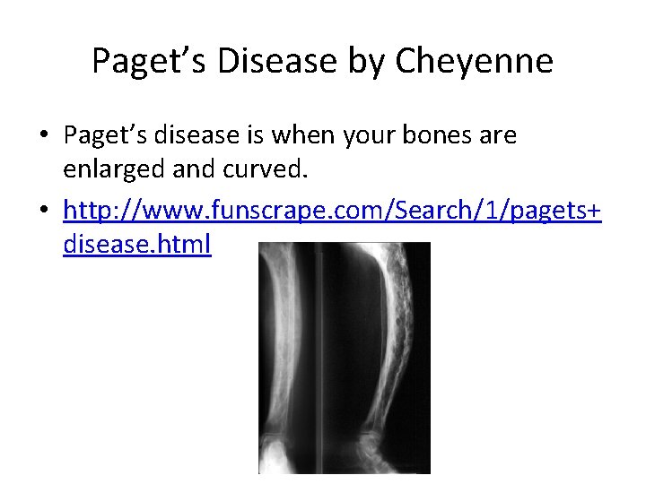 Paget’s Disease by Cheyenne • Paget’s disease is when your bones are enlarged and