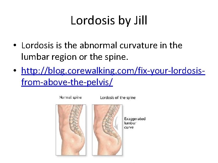 Lordosis by Jill • Lordosis is the abnormal curvature in the lumbar region or