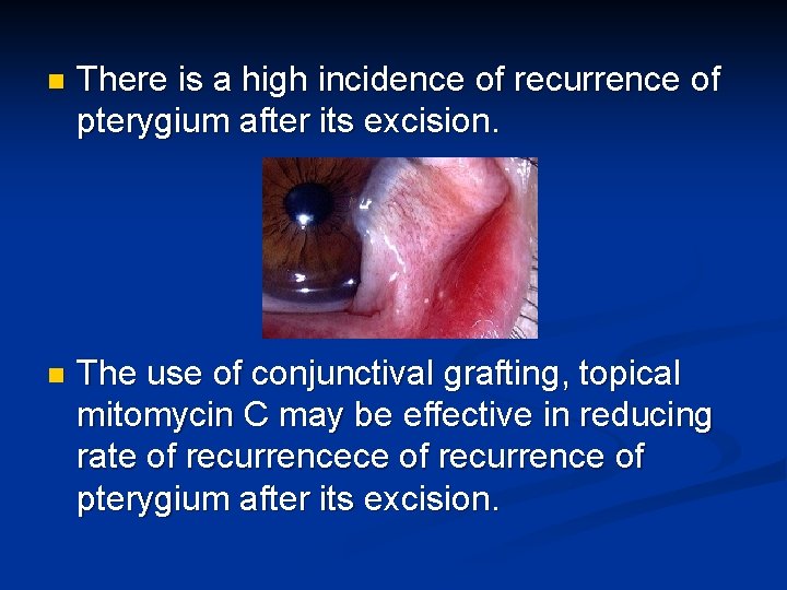 n There is a high incidence of recurrence of pterygium after its excision. n