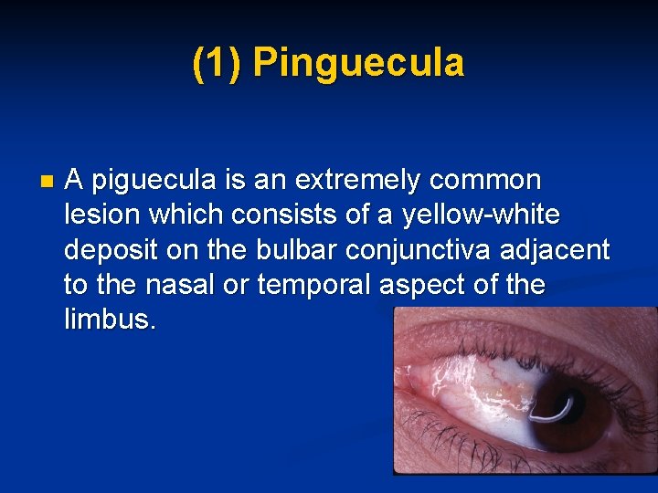 (1) Pinguecula n A piguecula is an extremely common lesion which consists of a