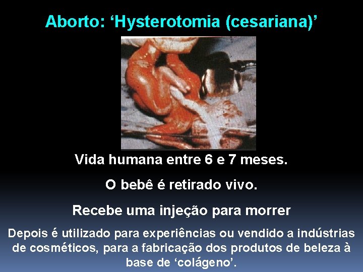 Aborto: ‘Hysterotomia (cesariana)’ Vida humana entre 6 e 7 meses. O bebê é retirado