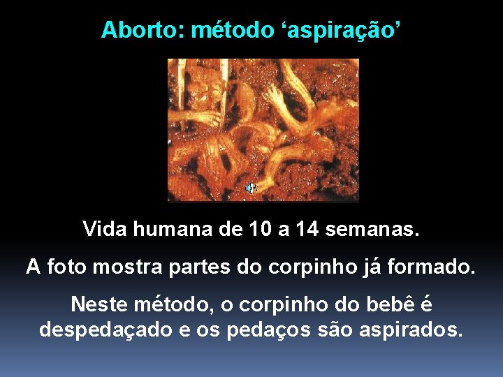 Aborto: método ‘aspiração’ Vida humana de 10 a 14 semanas. A foto mostra partes