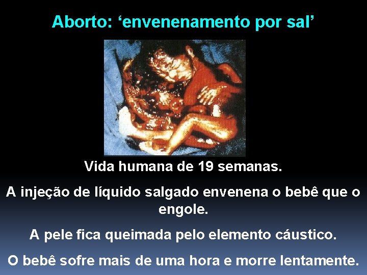 Aborto: ‘envenenamento por sal’ Vida humana de 19 semanas. A injeção de líquido salgado