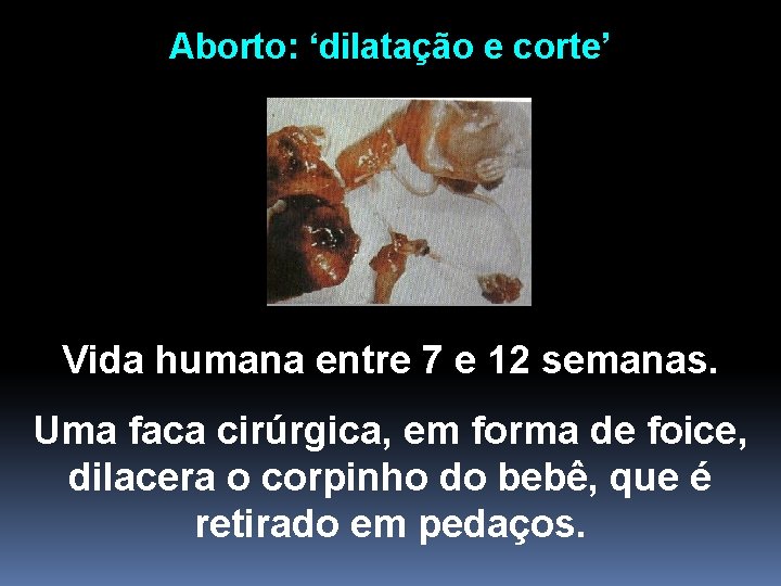 Aborto: ‘dilatação e corte’ Vida humana entre 7 e 12 semanas. Uma faca cirúrgica,