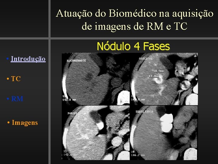 Atuação do Biomédico na aquisição de imagens de RM e TC Nódulo 4 Fases