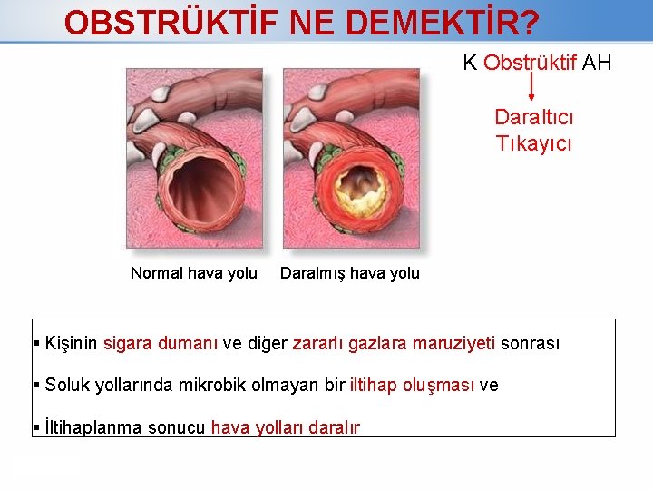 OBSTRÜKTİF NE DEMEKTİR? K Obstrüktif AH Daraltıcı Tıkayıcı Normal hava yolu Daralmış hava yolu