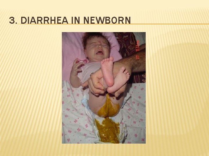 3. DIARRHEA IN NEWBORN 