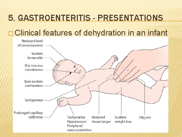 5. GASTROENTERITIS - PRESENTATIONS � Clinical features of dehydration in an infant 