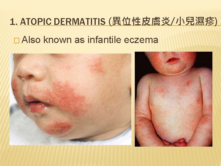 1. ATOPIC DERMATITIS (異位性皮膚炎/小兒濕疹) � Also known as infantile eczema 