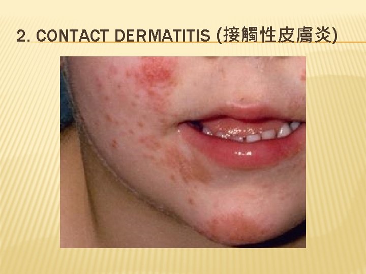 2. CONTACT DERMATITIS (接觸性皮膚炎) 