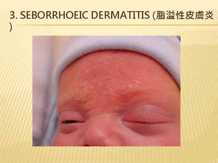 3. SEBORRHOEIC DERMATITIS (脂溢性皮膚炎 ) 