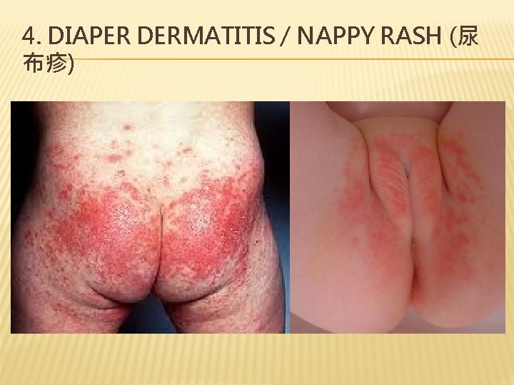 4. DIAPER DERMATITIS / NAPPY RASH (尿 布疹) 