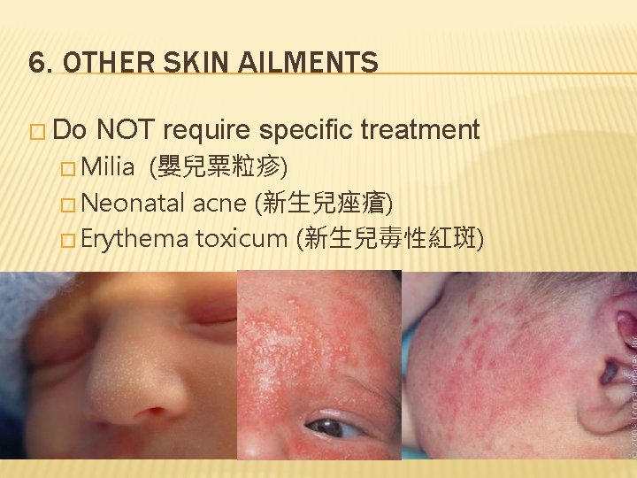6. OTHER SKIN AILMENTS � Do NOT require specific treatment � Milia (嬰兒粟粒疹) �