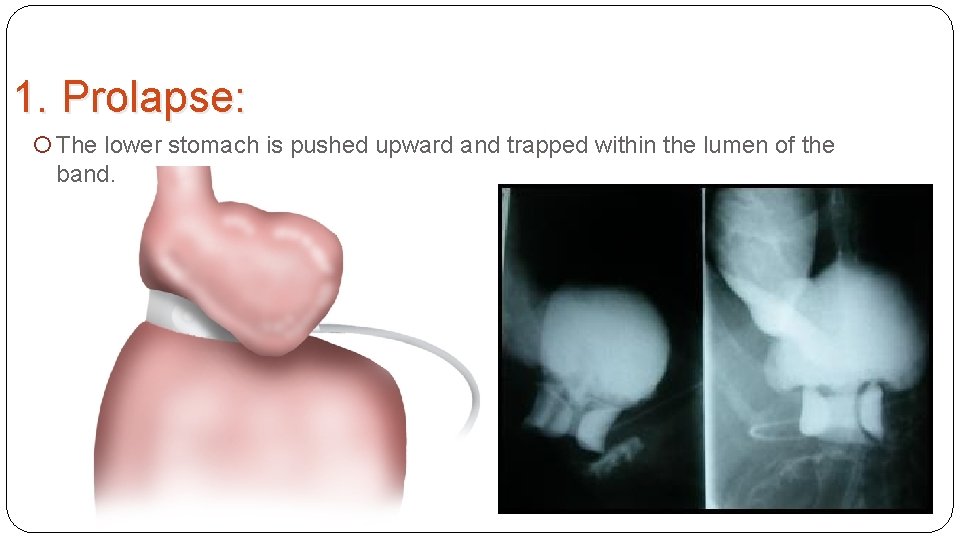 1. Prolapse: The lower stomach is pushed upward and trapped within the lumen of